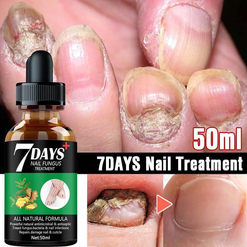 7DAYS Nail Fungus Treatment Serum, 50ml bottle, effective for cracked and discolored nails, promotes nail health.