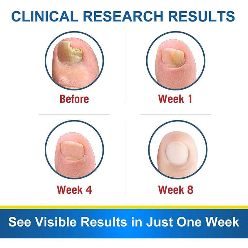 Before and after results of nail treatment showing improvements over 8 weeks, highlighting clinical effectiveness.