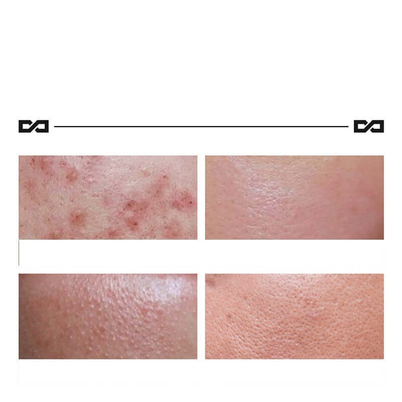 Before and after images showing acne improvement with Herbal Lightening Acne Cream for clear skin.