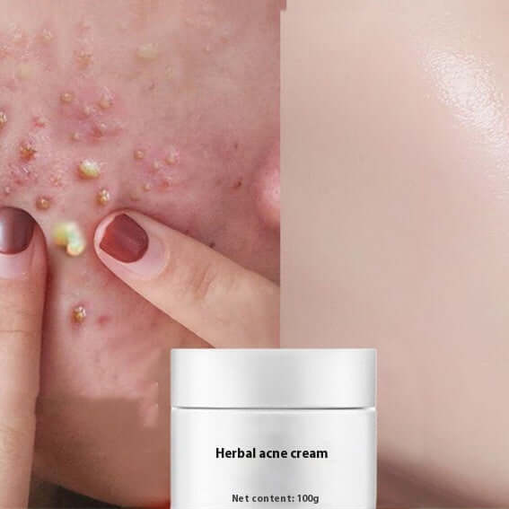 Herbal acne cream showcasing before and after results on skin, highlighting acne reduction and improved skin clarity.