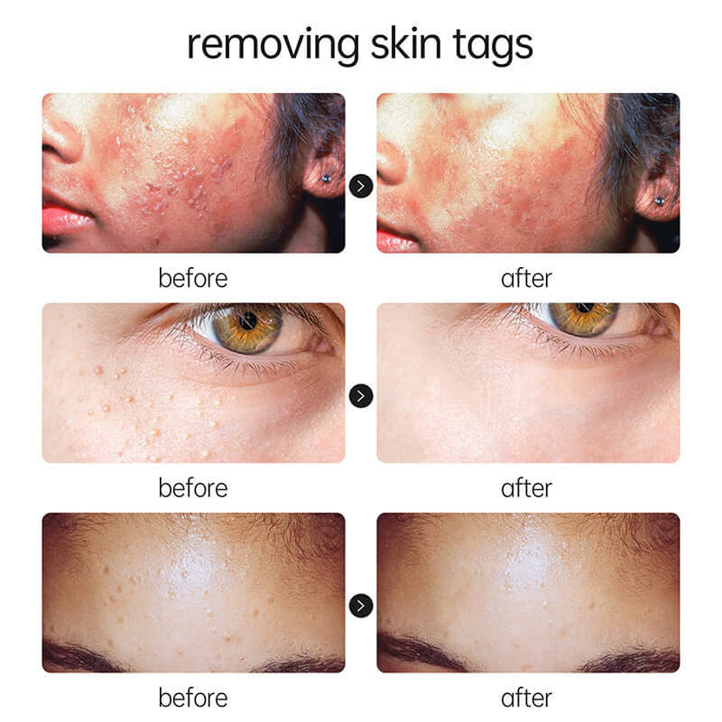 Before and after images showing skin tag removal results on various areas of the face for clearer skin.