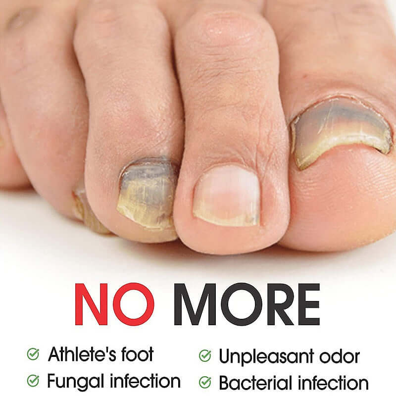 Close-up of toes affected by fungal infection, emphasizing relief from athlete's foot and unpleasant odor.
