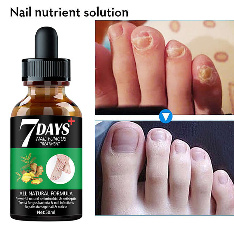 7DAYS Nail Fungus Treatment Serum for restoring cracked, discolored toenails and fighting nail infections.