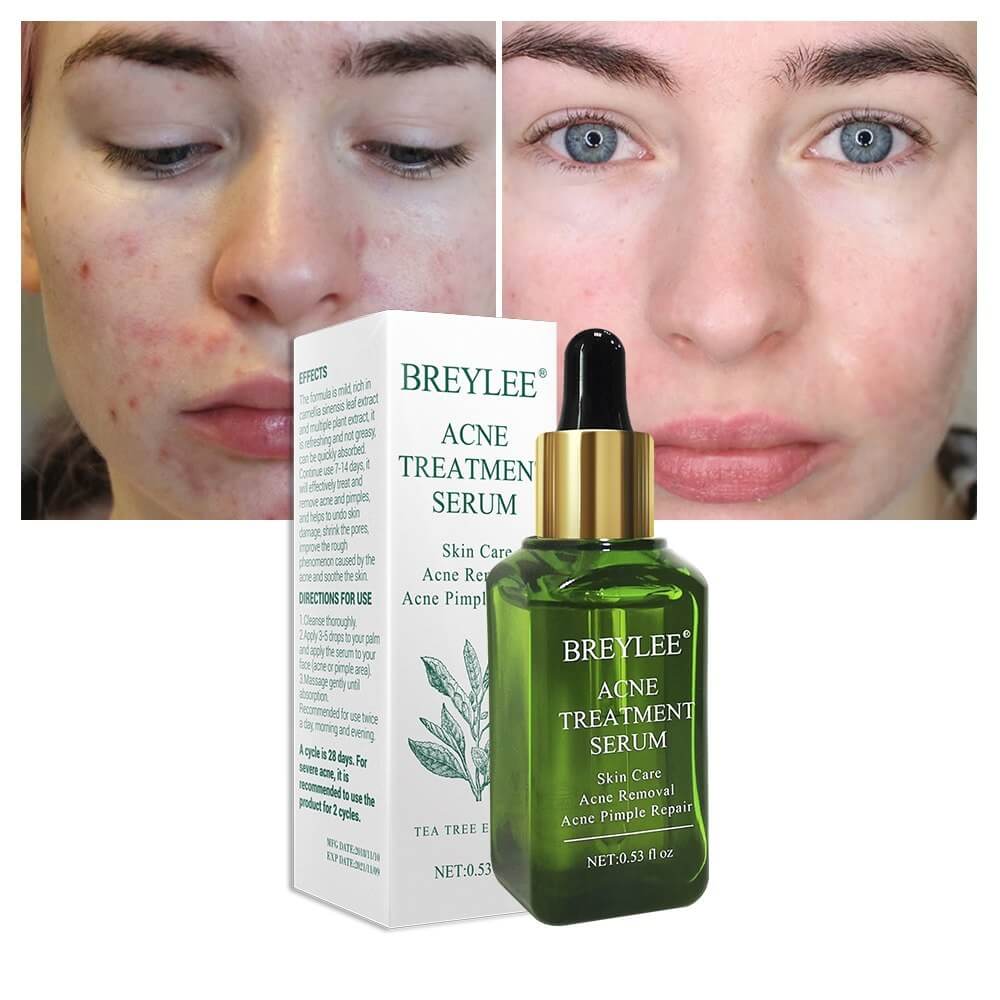 BREYLEE Acne Treatment Serum shown with before and after photos, highlighting acne scar improvement and skin repair.
