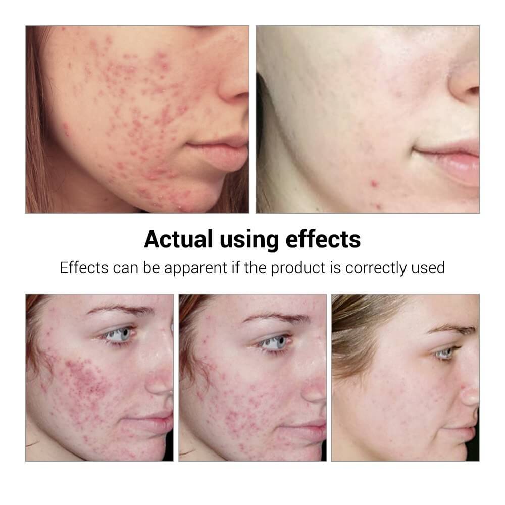Before and after images showing the effects of BREYLEE Acne Treatment Serum on acne and pimples.