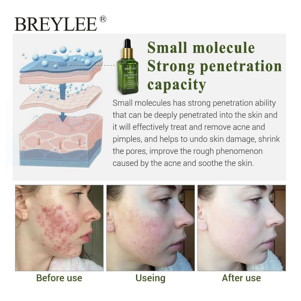 BREYLEE acne treatment serum benefits with before and after comparison, highlighting skin improvement and acne scar reduction.