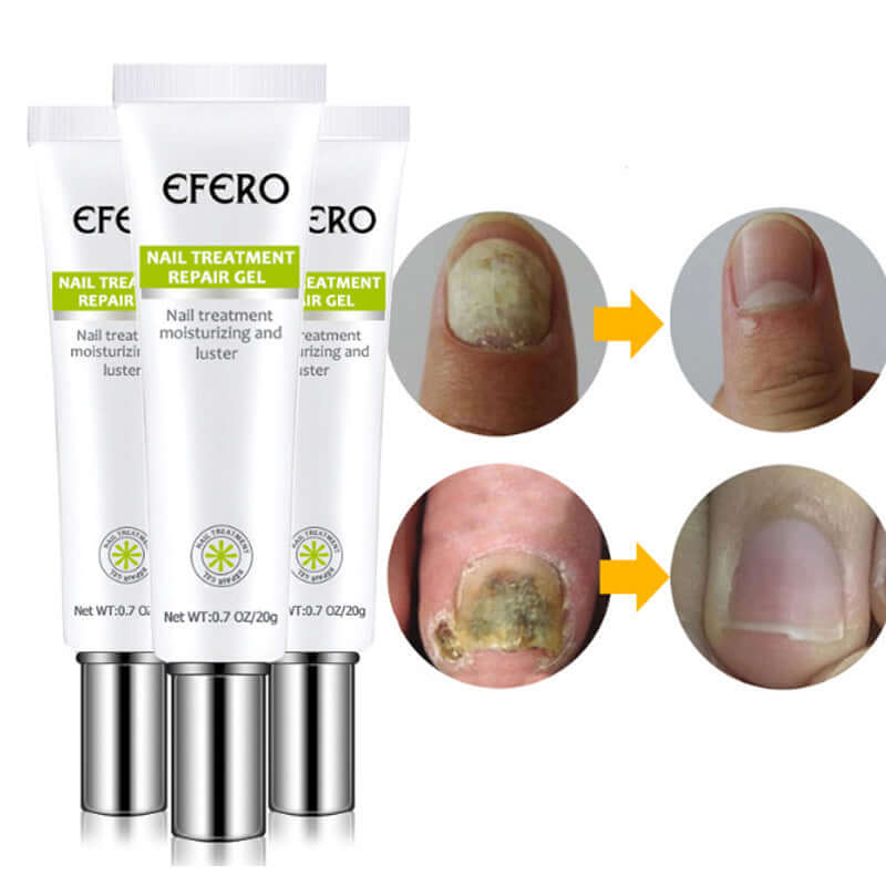 Three tubes of EFERO Nail Treatment Repair Gel for onychomycosis nail fungus removal and nail care.