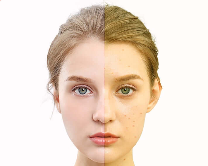 Before and after photo showing skin improvement using Photon Skin Rejuvenation Instrument, highlighting clearer skin.